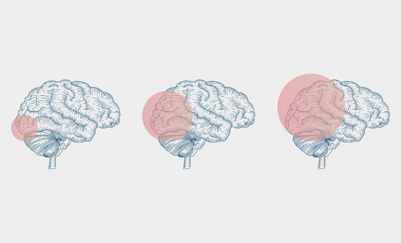 An illustration of three brains in lateral view, each overlaid with a sequentially enlarging red dot that represents cortical spreading depression.